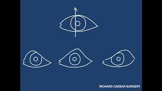 Ptosis Tutorial  A Practical Approach [upl. by Hedvah]