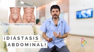 ¿QUÉ ES LA DIÁSTASIS ABDOMINAL [upl. by Harley]