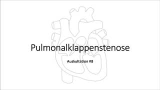 Auskultation 8 Pulmonalklappenstenose [upl. by Winn]