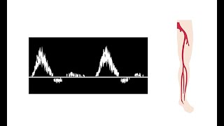 Interpreting duplex waveforms [upl. by Tisbe783]