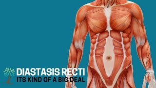 Heres Why Diastasis Recti is a Big Deal  Diastasis Ed 1 [upl. by Ayotahs166]