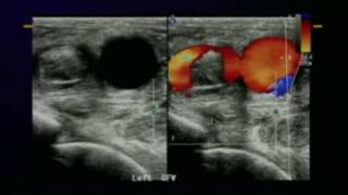 Lower Extremity Venous Protocols and Interpretation [upl. by Leirvag585]