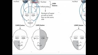 Lecture on eyelid and brow ptosis [upl. by Aronael96]