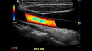 Normal Carotid Duplex [upl. by Grete]