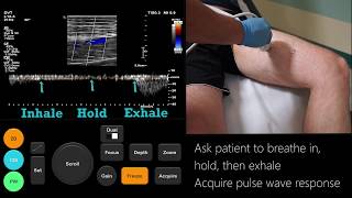 Ultrasound Tutorial DVT  Lower Limb Veins  Radiology Nation [upl. by Unity401]