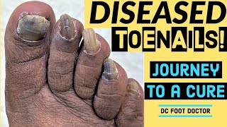 Diseased Toenails Journey To A Cure Trimming Fungal Toenails Onychomycosis [upl. by Lamberto]